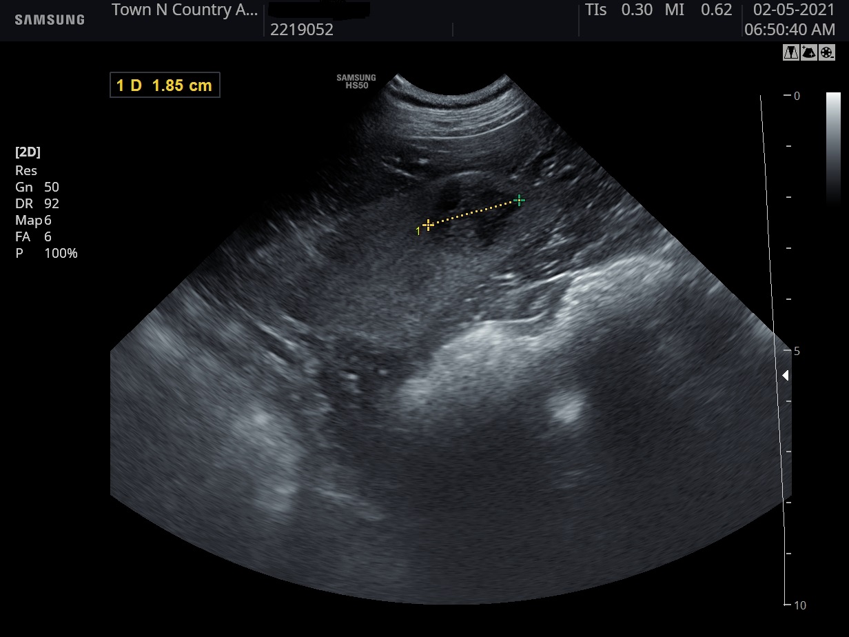 ultrasound